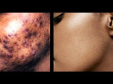 ACNE GEL ( dark spot remover)