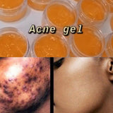 ACNE GEL ( dark spot remover)