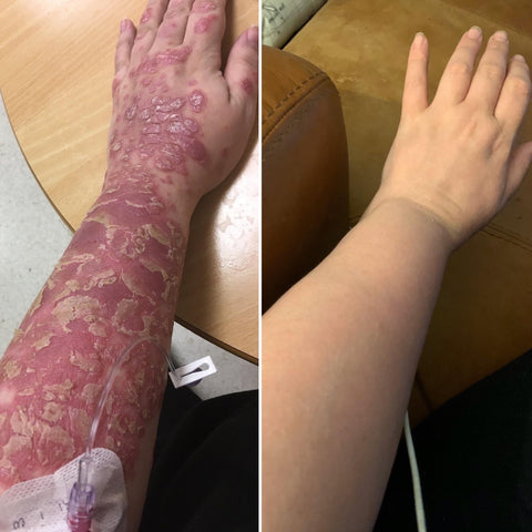 ECZEMA & PSORIASIS BODY BUTTER