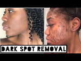 ACNE GEL ( dark spot remover)